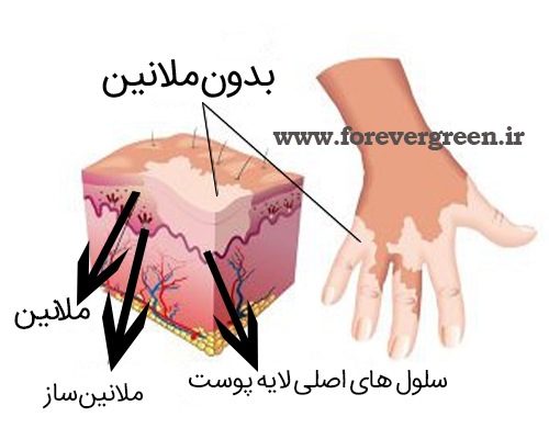 مشکلات پوستی ملانین